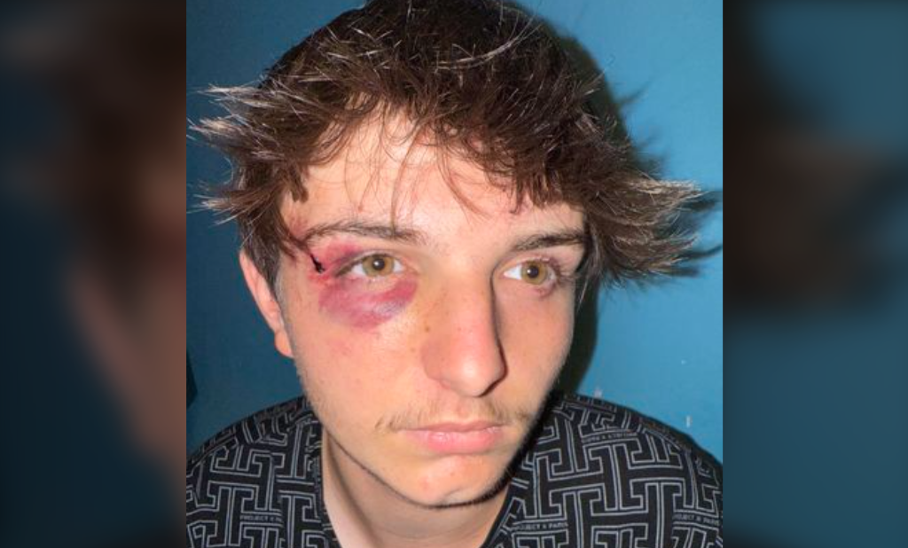 Nouveau agression homophobe: Une dizaine de salopard ont tabassé un un homme gay à Mazamet, dans le Tarn. La victime, qui présente un traumatisme crânien, a été hospitalisée mais certains des agresseurs ont essayé de le tabasser à nouveau à l&rsquo;hôpital