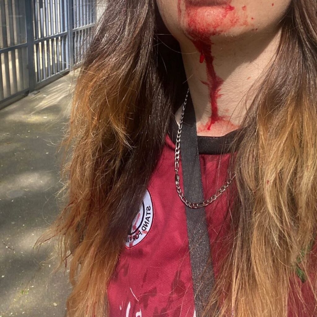 Dimanche à Paris, une jeune femme a été violemment agressée par des sionistes, car elle portait un t-shirt de la Palestine, en solidarité avec les Palestiniens de Gaza. Résultats 5 points de suture mais pereonne ne parlera de la plainte qu&rsquo;elle a déposée
